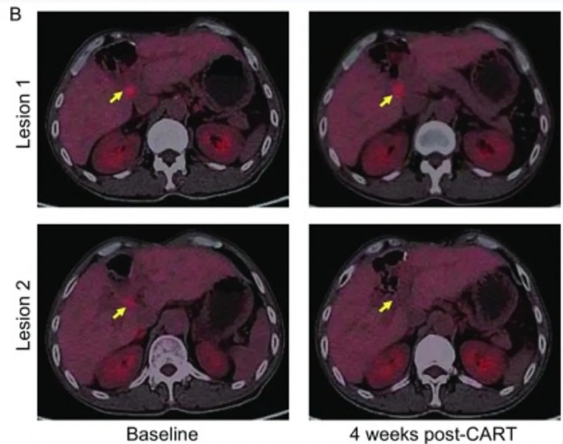 CAR-T-HER2细胞疗法治疗效果