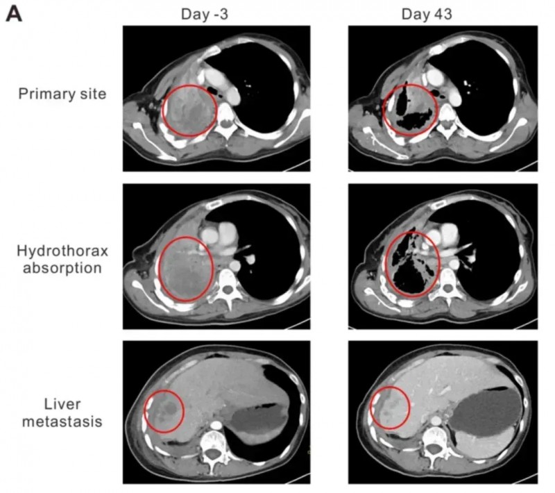 NY-ESO-1 TCR-T治疗非小细胞肺癌的效果