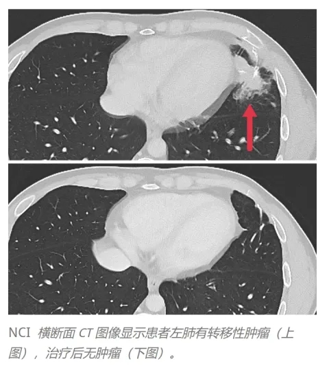TCR-T疗法治疗结直肠癌的效果