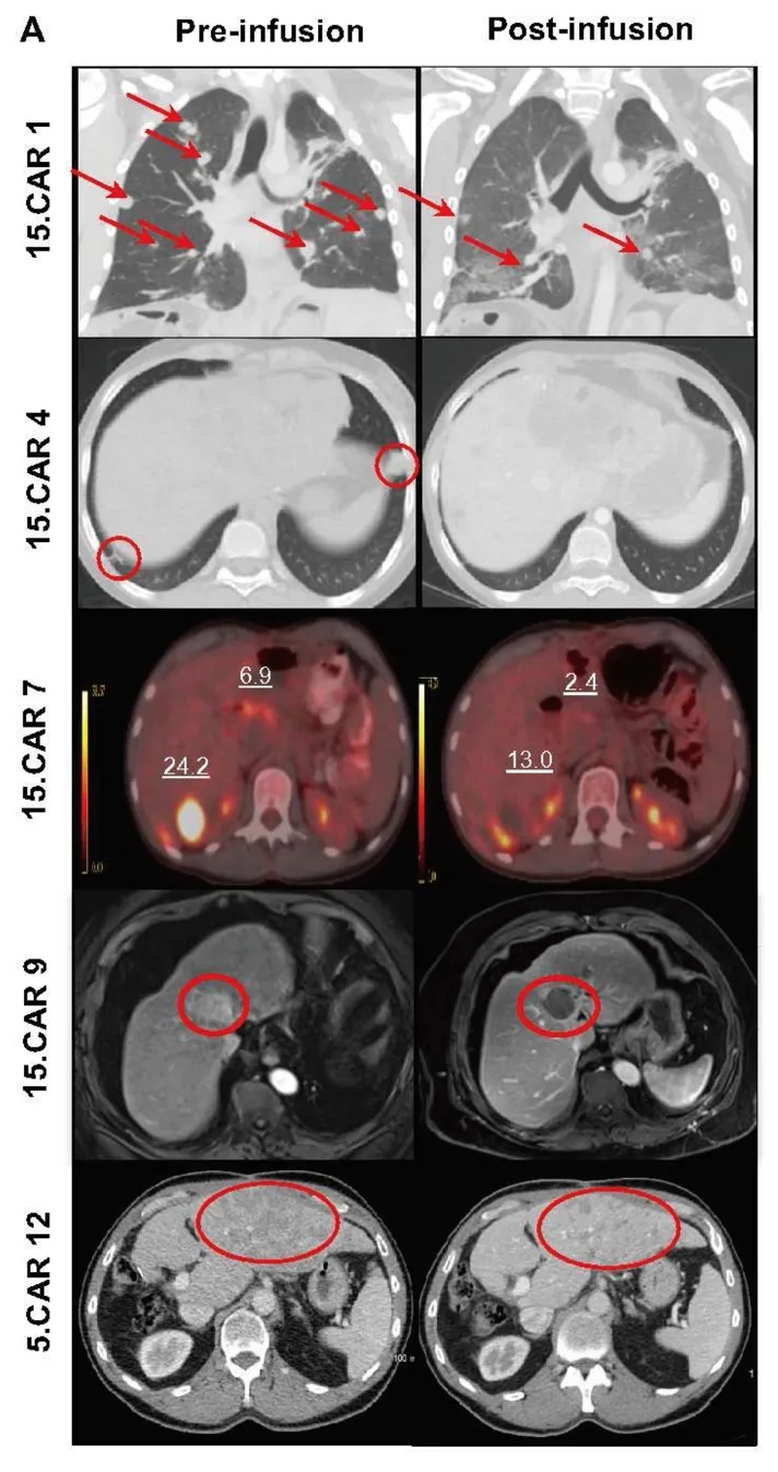 GPC3-CAR-T治疗效果