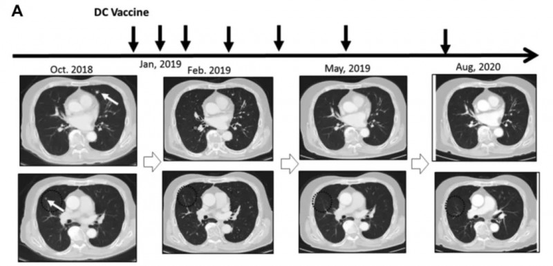 DC细胞治疗肾癌的效果
