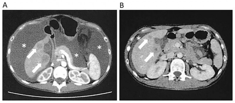 NK细胞疗法联合DC疫苗治疗子宫内膜癌腹水的效果