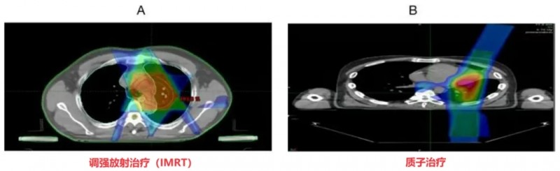 肺癌质子治疗和传统放疗对比