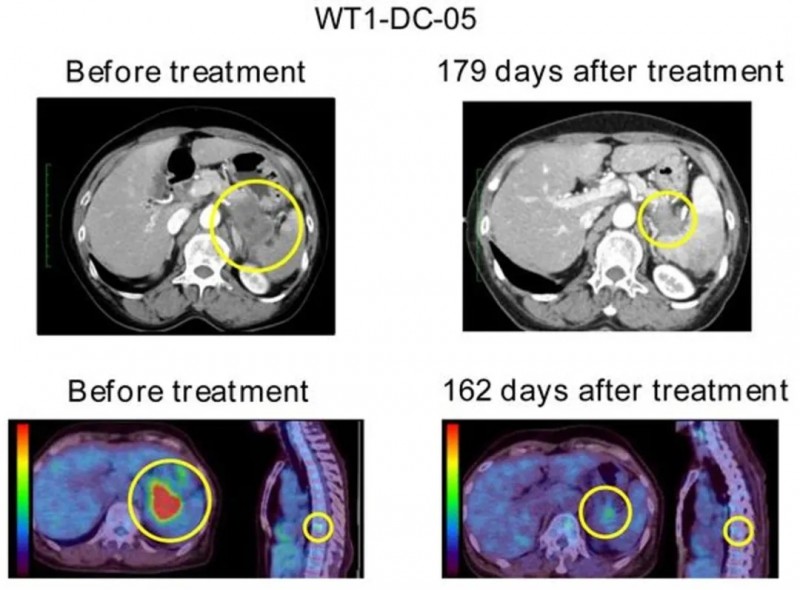 WT1-DDC疫苗治疗胰腺癌的效果
