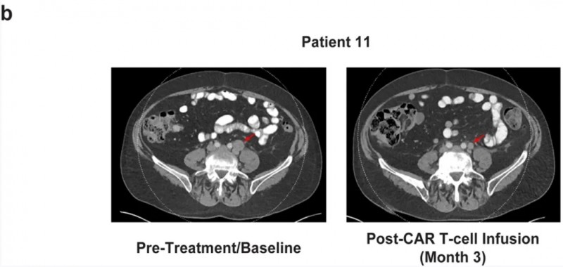 TGFβ盔甲式CAR-T治疗前列腺癌的效果