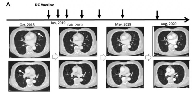 转移灶消失了!新抗原肽DC疫苗对多癌种显