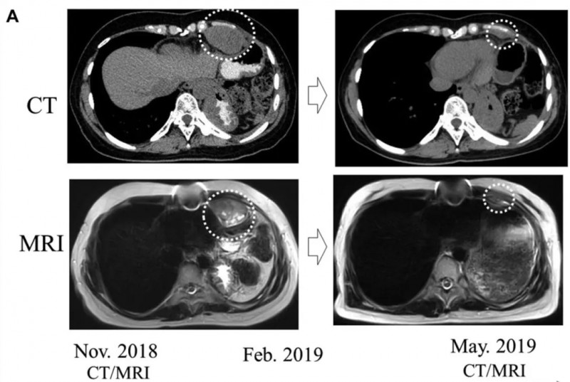 DC疫苗治疗女性恶性胸腺瘤胸膜转移的效果