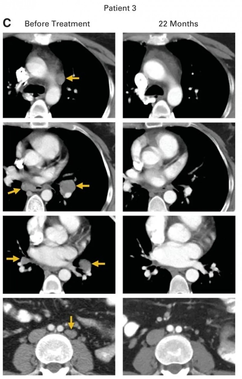 HPV-TIL细胞疗法治疗转移性宫颈癌的效果