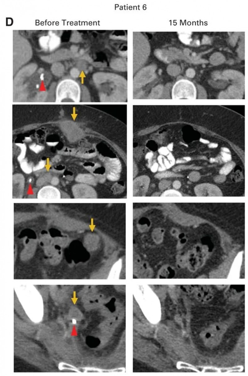 HPV-TIL细胞疗法治疗转移性宫颈腺癌的效果