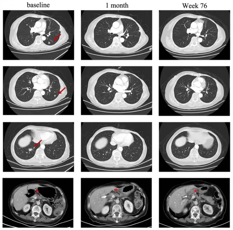 CLDN18.2靶向CART细胞疗法治疗胰腺癌的效果