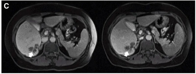 CEA CART治疗结直肠癌的效果