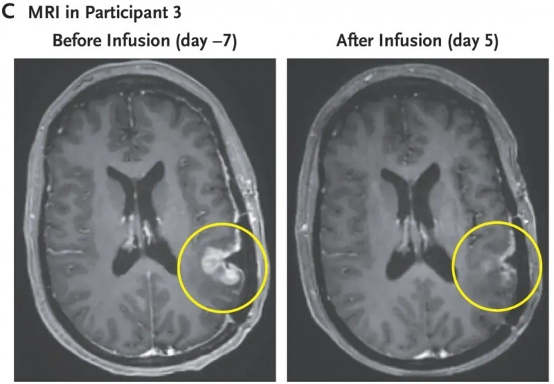 EGFRvIII CART治疗胶质母细胞瘤的效果