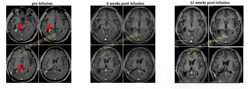 TIL细胞疗法治疗脑胶质瘤的效果