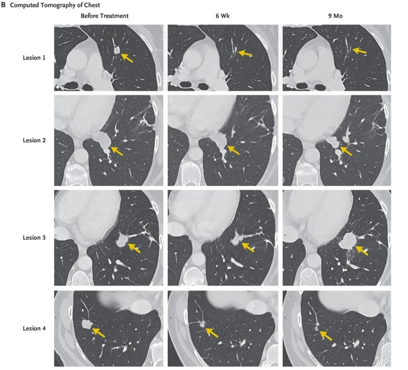 TIL细胞疗法治疗结直肠癌的效果