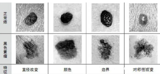 V940治疗黑色素瘤的效果