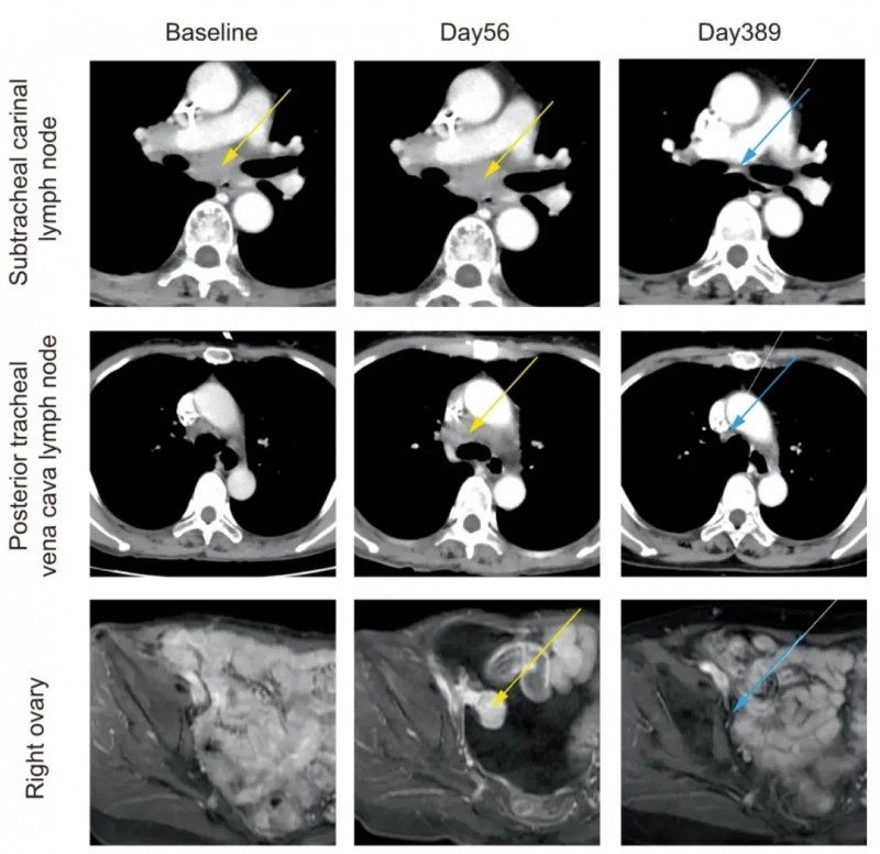 Neo-MoDC疫苗治疗胃癌的效果