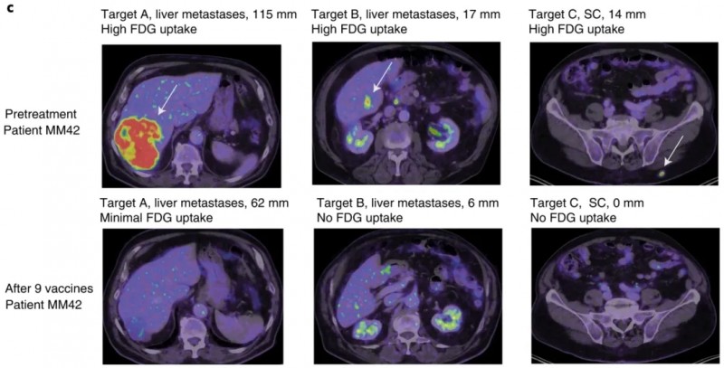 IO102-IO103疫苗治疗黑色素瘤的效果