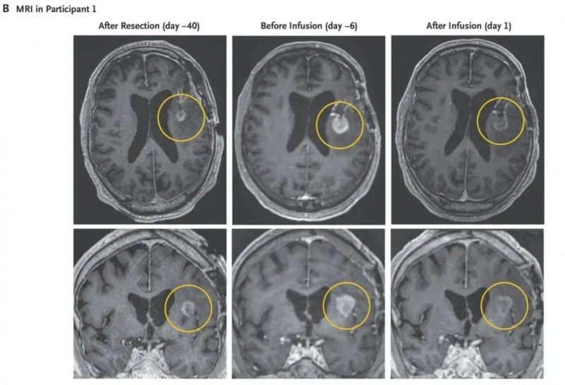 CAR-T治疗EGFRvIII阳性胶质母细胞瘤的效果
