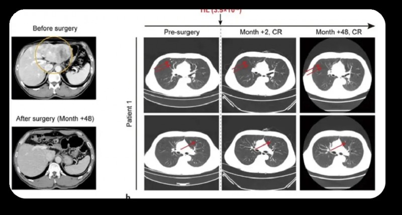 TIL+PD-1+AI三联疗法治疗晚期肝癌的效果