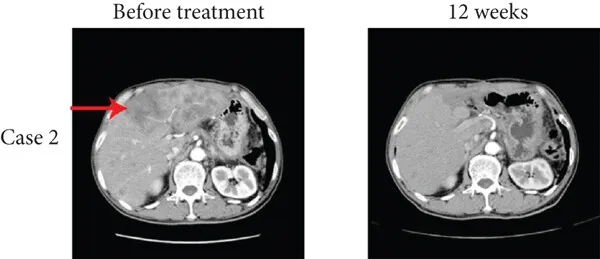 TIL细胞疗法联合PD-1治疗骨肉瘤肝转12周的效果