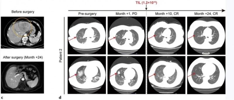 TIL细胞疗法治疗肝癌的效果