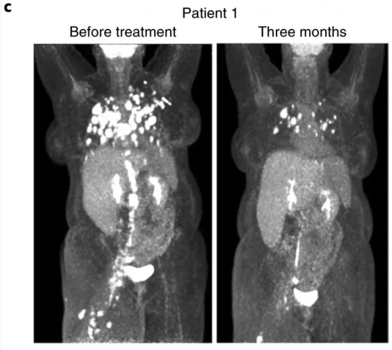 E7 TCR-T疗法治疗HPV阳性的转移性外阴鳞状细胞癌的效果