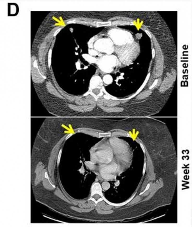 PD-1抑制剂的治疗效果
