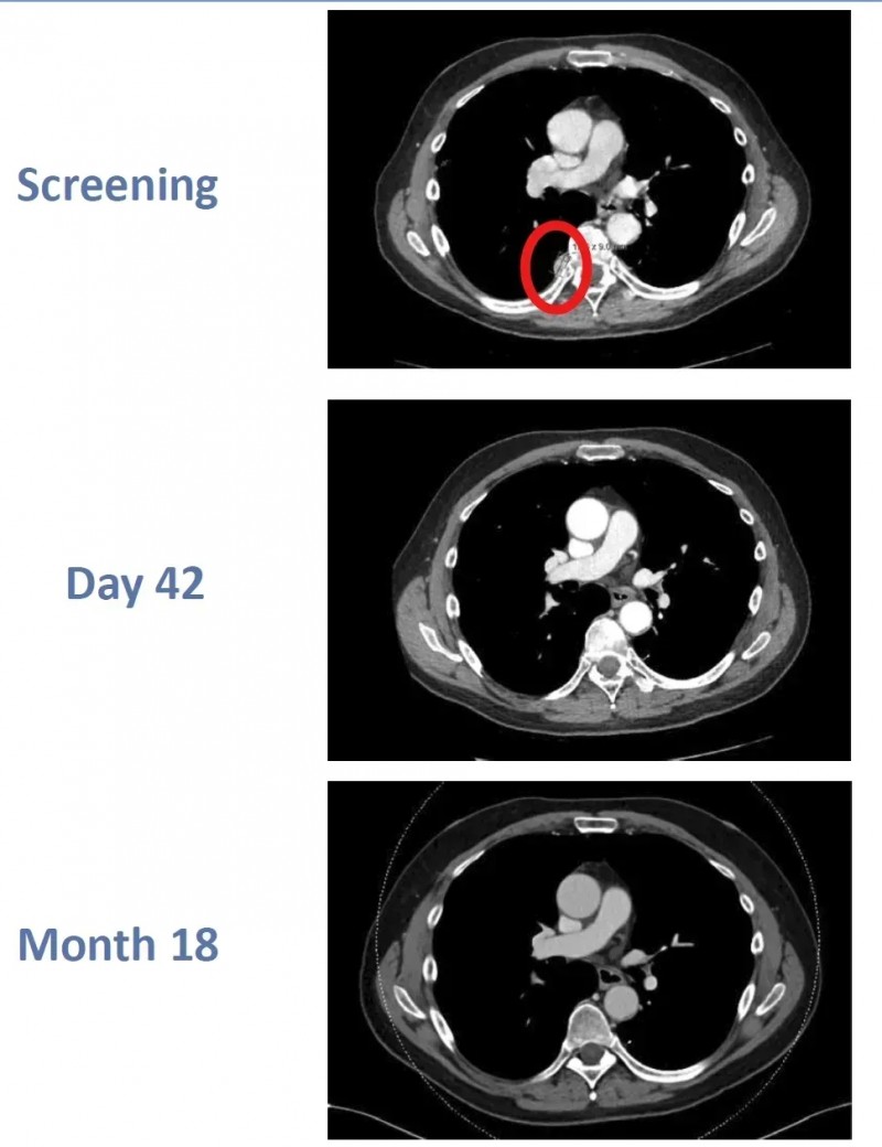 CD70 CAR-T疗法CTX130治疗肾癌的效果