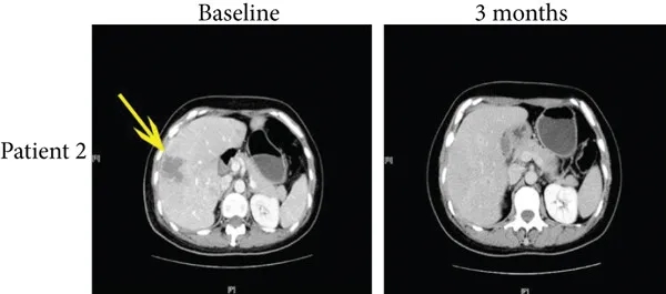 TIL细胞疗法联合PD-1治疗化疗耐药宫颈癌伴肝转移的效果