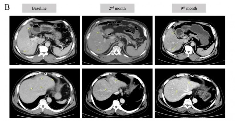 癌症疫苗治疗结直肠癌的效果