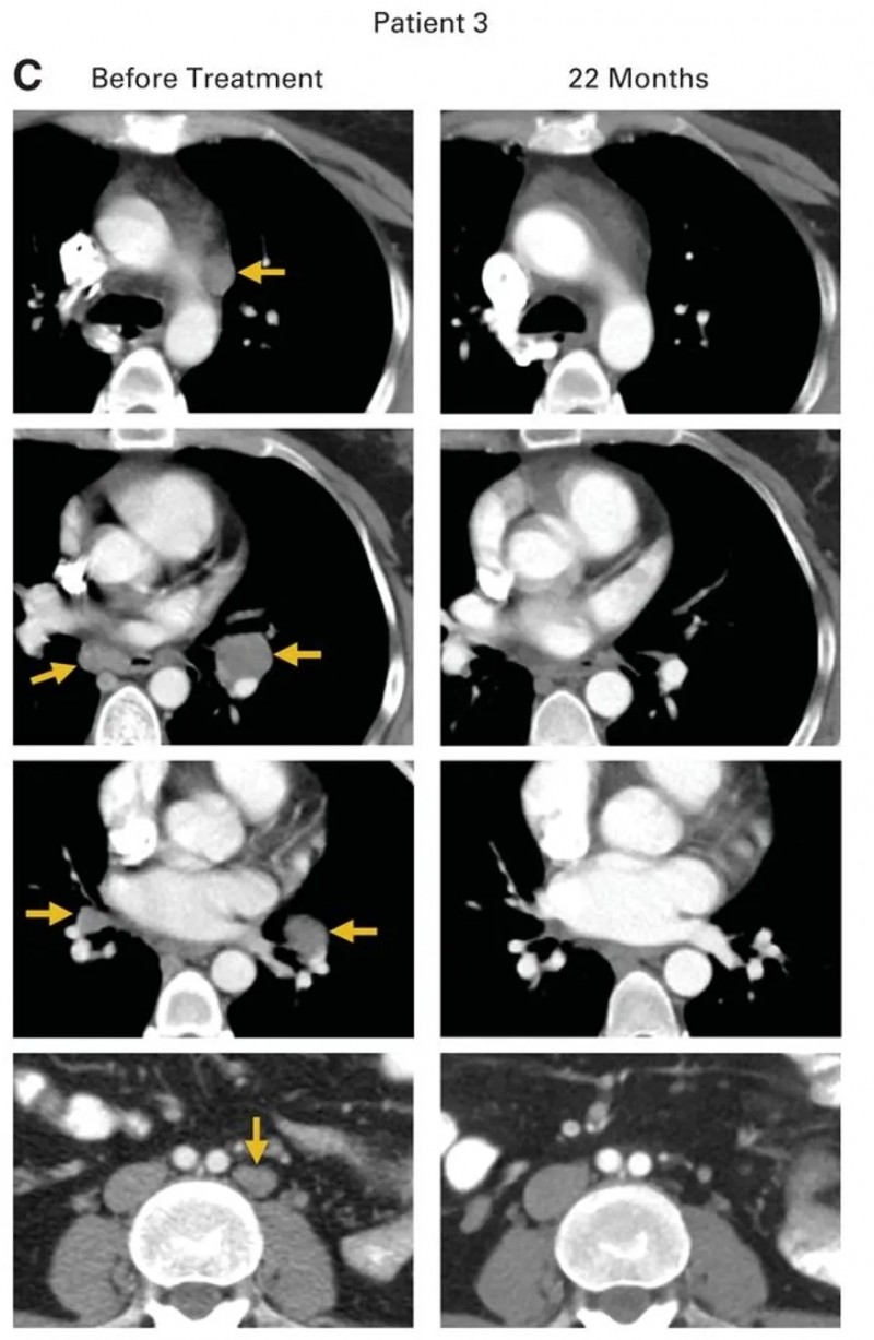 HPV-TIL细胞疗法治疗宫颈癌的效果