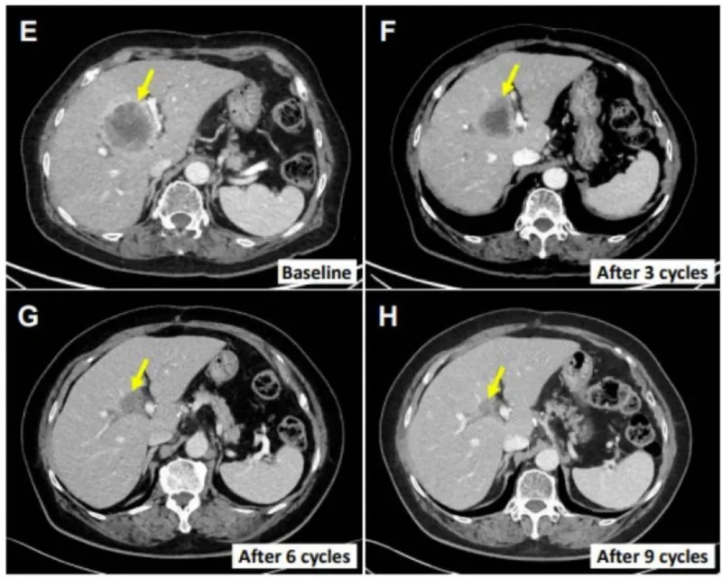SMT-NK疗法联合帕博利珠单抗治疗胆道癌的效果