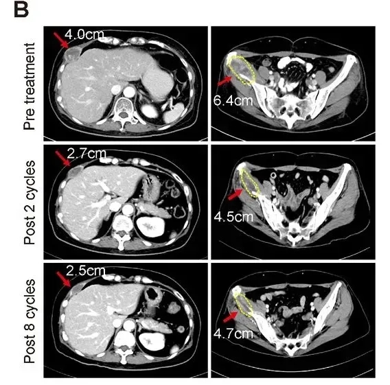 NK细胞疗法联合曲妥珠单抗治疗HER2阳性乳腺癌的效果