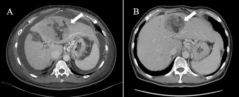 三免疫疗法治疗肝癌的效果
