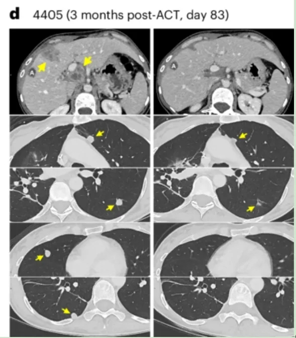 TCRT细胞疗法治疗晚期难治结直肠癌的效果