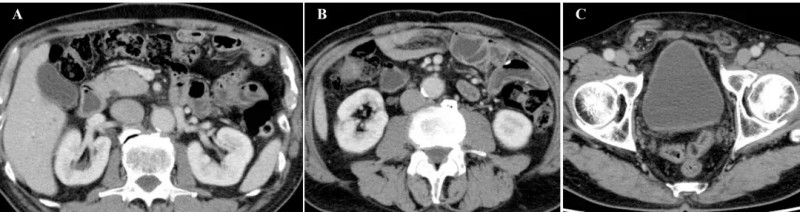 DC疫苗治疗十二指肠癌1个月后的效果