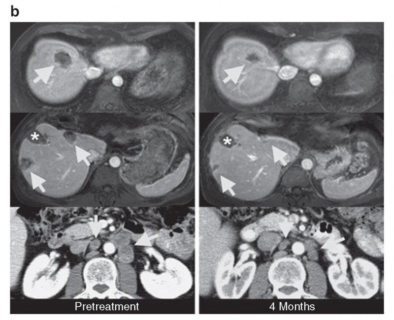 CEA TCR-T细胞疗法治疗结直肠癌的效果