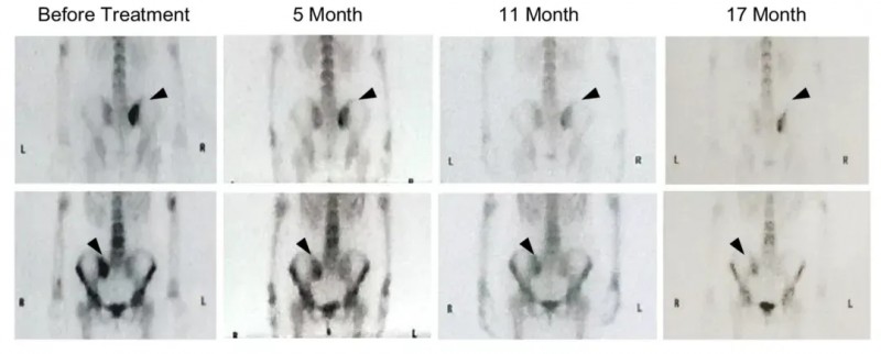MASCT疗法治疗宫颈癌的效果