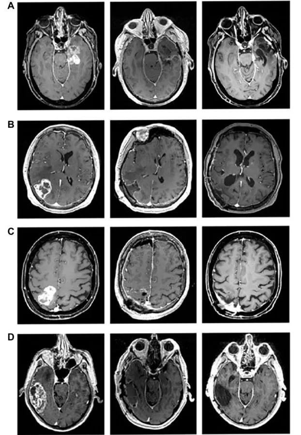 GV-001治疗胶质母细胞瘤的效果