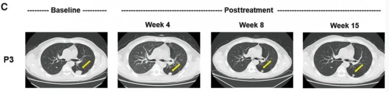 GPC3 CART细胞疗法治疗肝癌的效果