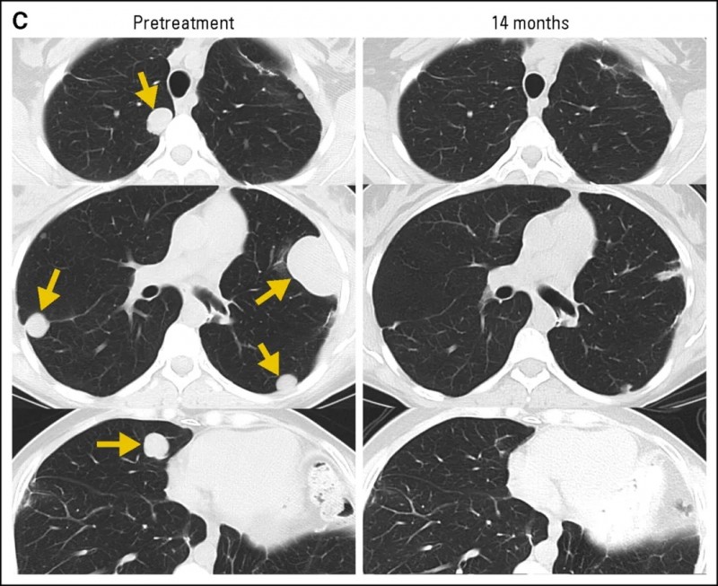 NY-ESO-1 T细胞疗法治疗滑膜肉瘤的案例