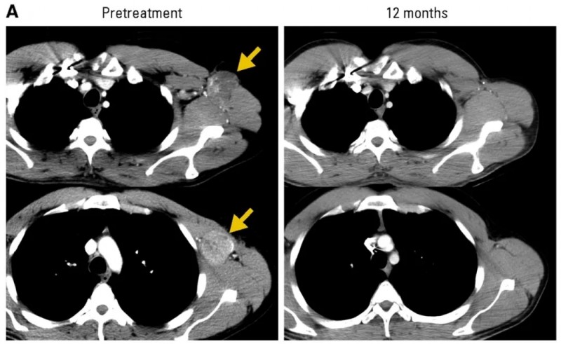 NY-ESO-1 T细胞疗法治疗黑色素瘤的效果