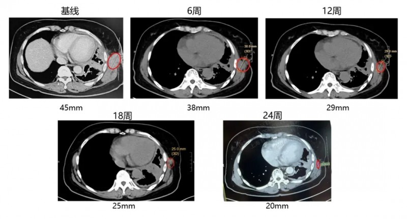 GC101 TIL细胞疗法治疗晚期肺腺癌的效果