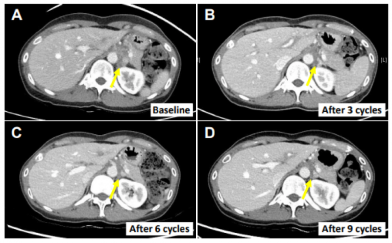 SMT-NK联合帕博利珠单抗治疗胆道癌左肾淋巴结的效果