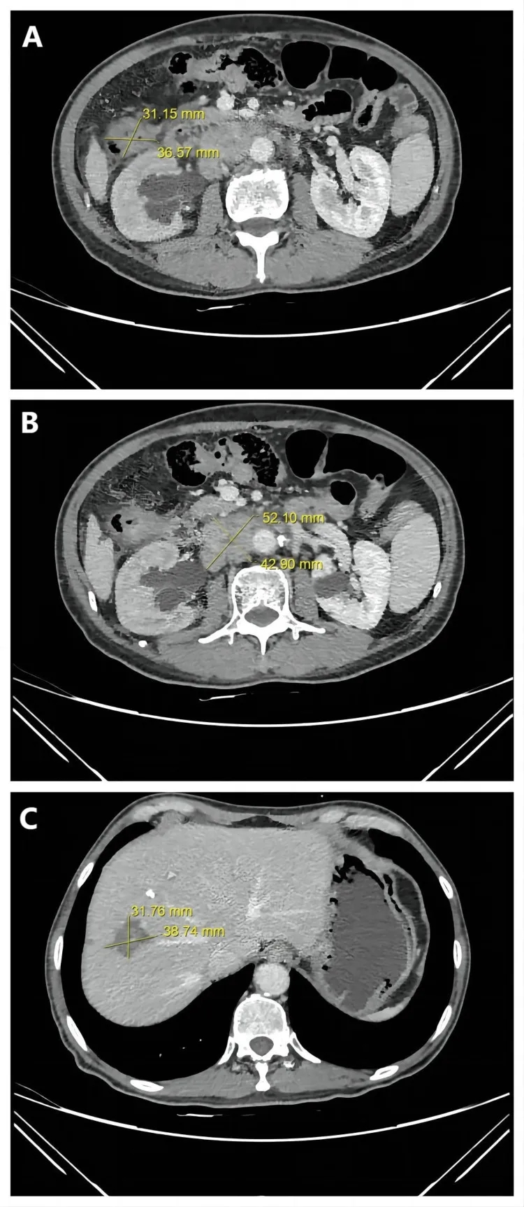 粪菌移植联合替雷利珠单抗+贝伐珠单抗治疗晚期结直肠癌的效果