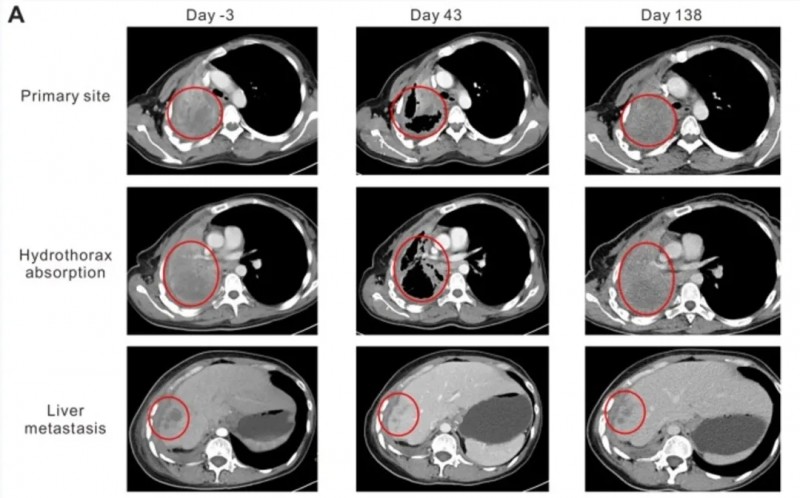 NY-ESO-1治疗肺癌的效果