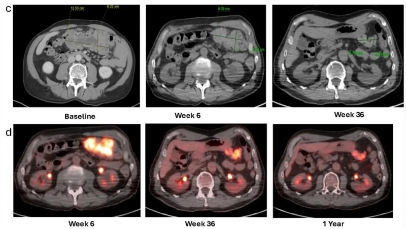 TIL细胞疗法治疗晚期黑色素瘤的效果