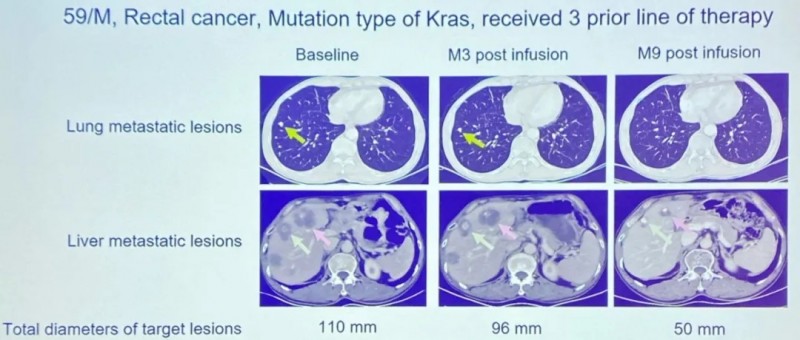 IM96 CAR-T治疗结直肠癌的案例