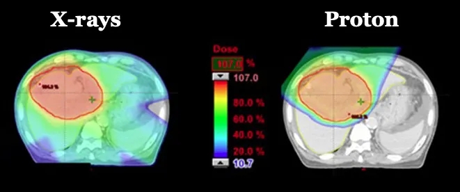 质子和重离子治疗的辐射优势