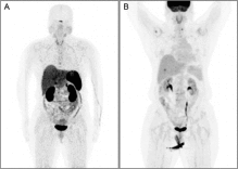 恩曲替尼治疗肺癌转移灶的效果